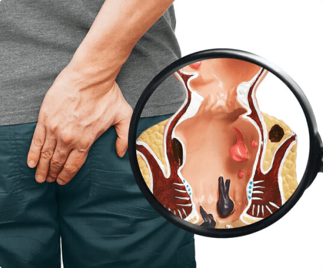 Hemorrhoids Treatment