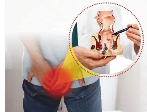 Hemorrhoids Types and Treatment Options