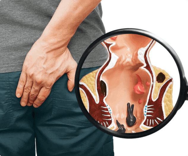 Hemorrhoids / Piles Surgery