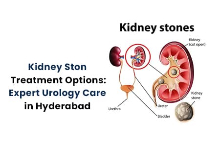 Kidney Stone Treatment Options Expert Urology Care in Hyderabad